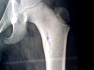 A Bone Fracture Leads CPS to Remove Two Girls from Their Home Xray vision...but not for justice.