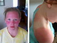 BOLD SOCIAL POLICY, 2017: Five Years After Girls’ Severe Sunburn, Washington Considers Bill to Let Students Use Sunscreen Without Doctor’s Note The daughters of Jess Michener, after school refused to let them use sunscreen without a doctor's note.