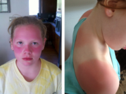 The daughters of Jess Michener, after school refused to let them use sunscreen without a doctor's note. 